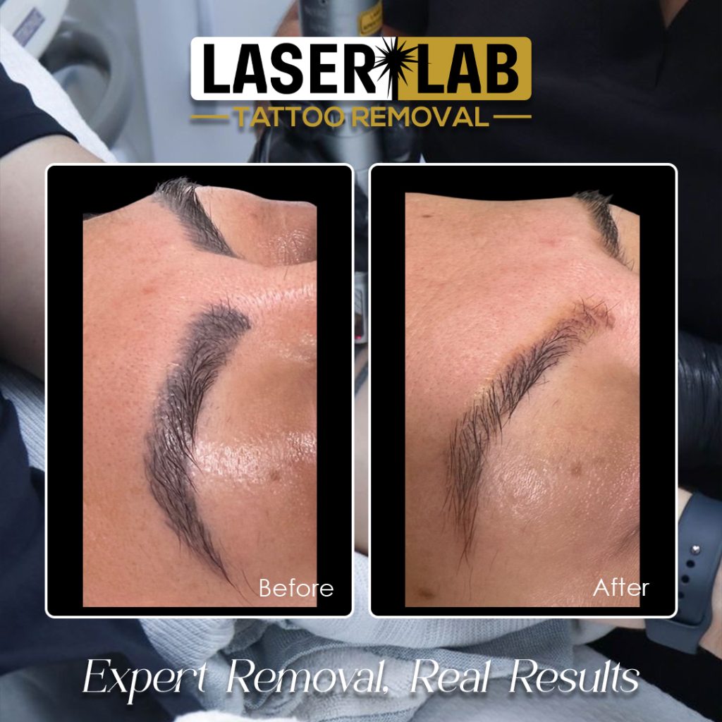 Cairns Laser Eyebrow & Cosmetic Tattoo Removal