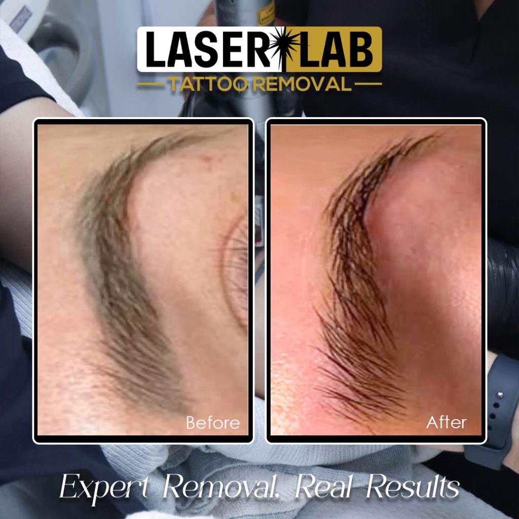 cosmetic tattoo removal