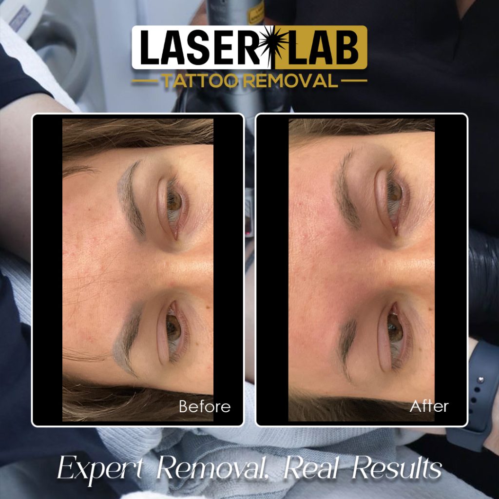 Cairns Laser Eyebrow & Cosmetic Tattoo Removal