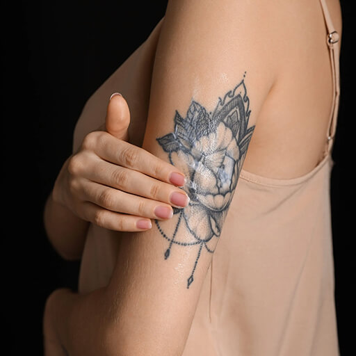 laser tattoo removal aftercare Cairns and Townsville healing process